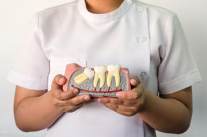 “Do I Really Need to Get My Wisdom Teeth Removed?” Blog Restorative Dentistry 